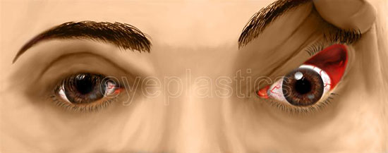 Image depicting a person with floppy eyelid syndrome